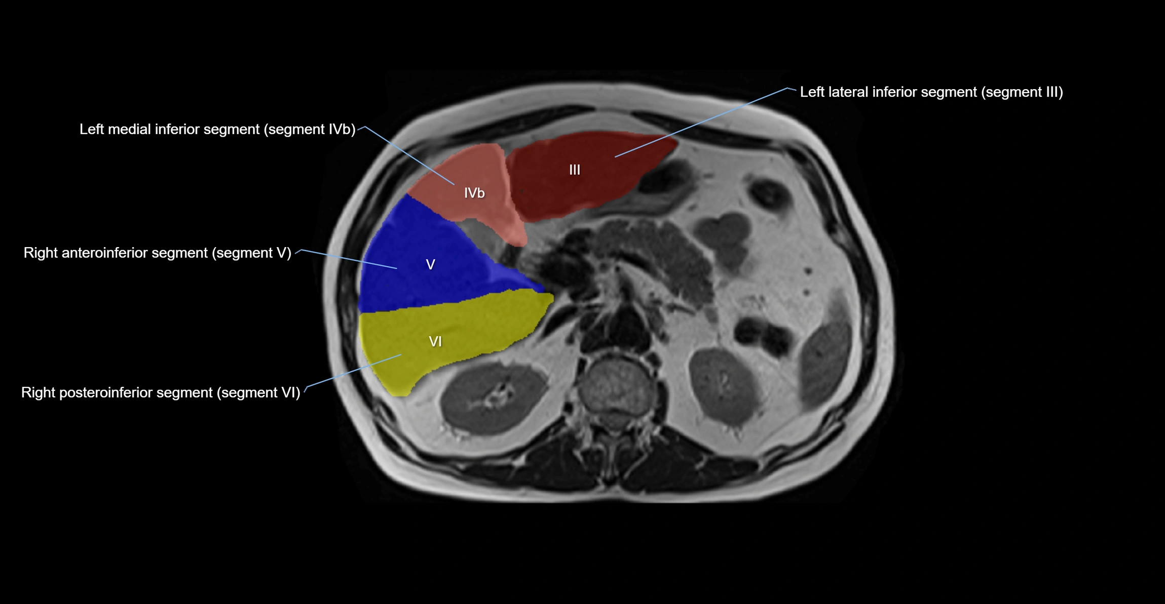 MRI  liver segments anatomy axial cross sectional 3T radiology  image-img-00001-00017.webp